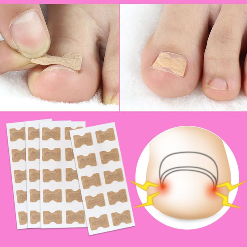 1/5pc Toe sticker Ingrown Toenail Correction stickers Pedicure Tool Toe Inlay Nail Corrector Nail Patch Correction Stickers