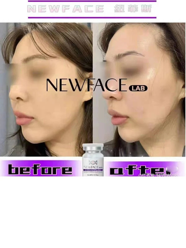 Newface-Lab-Skin-Booster-Skin-Moisture-Face-Lifting-Non-Corss-Linked-Hyaluronic-Acid-3ml-Dermal-Filler-Dmae.webp (9)