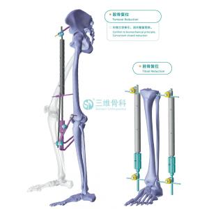 PriceList for Femur Fracture Redcution Minimally Invasive Reduction Frame supply to Cyprus Factory