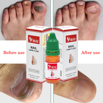 Herbs Fungal Nail Treatment Toe Nail Fungus Removal Gel Feet Care Essence Nail Foot Whitening Bright Anti Infection Dropshipping