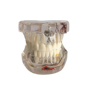 2021 New Dental Disease Implant Teeth Model with Restoration Bridge Tooth Dentist for medical Science Disease Teaching Study