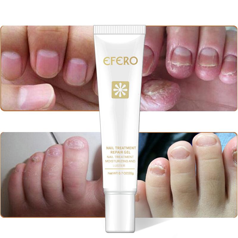 1 Pc Hands Feet Nail Care Whitening Toe Nail Fungal Fungus Removal Anti Cream Nourishing Repair Tool TSLM2