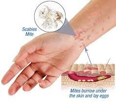 Metrin Skin Cream Permethrin 5% 30 GR - Treatment of Parasites Caused by Scabies and Pubis Lice, Over Itching (6 Pack)