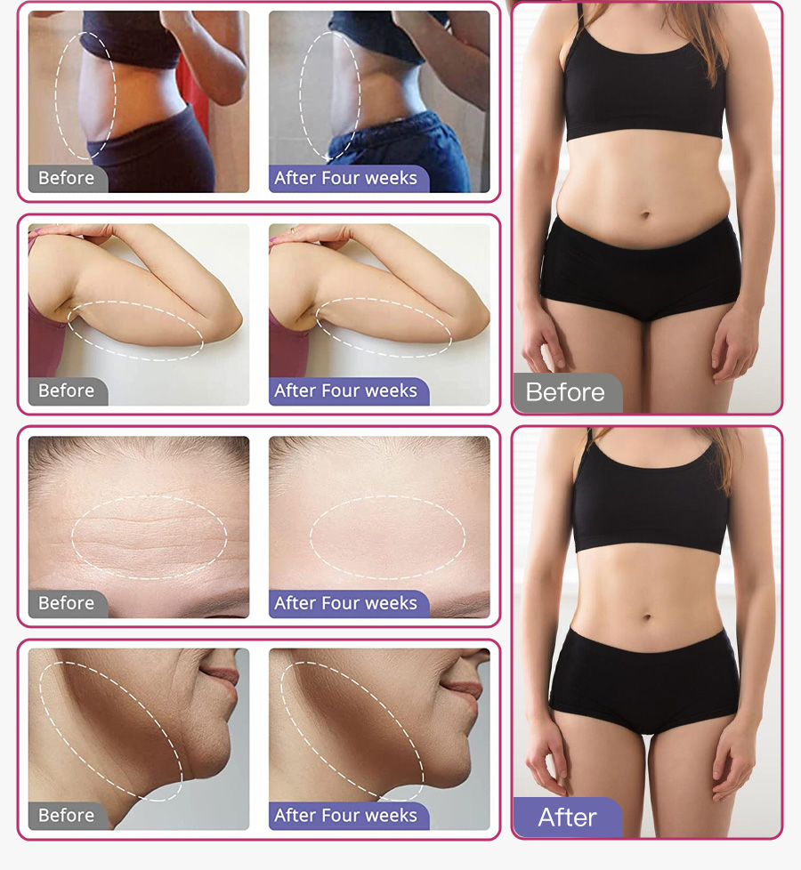 Omeina ultrasonic fat cavitation