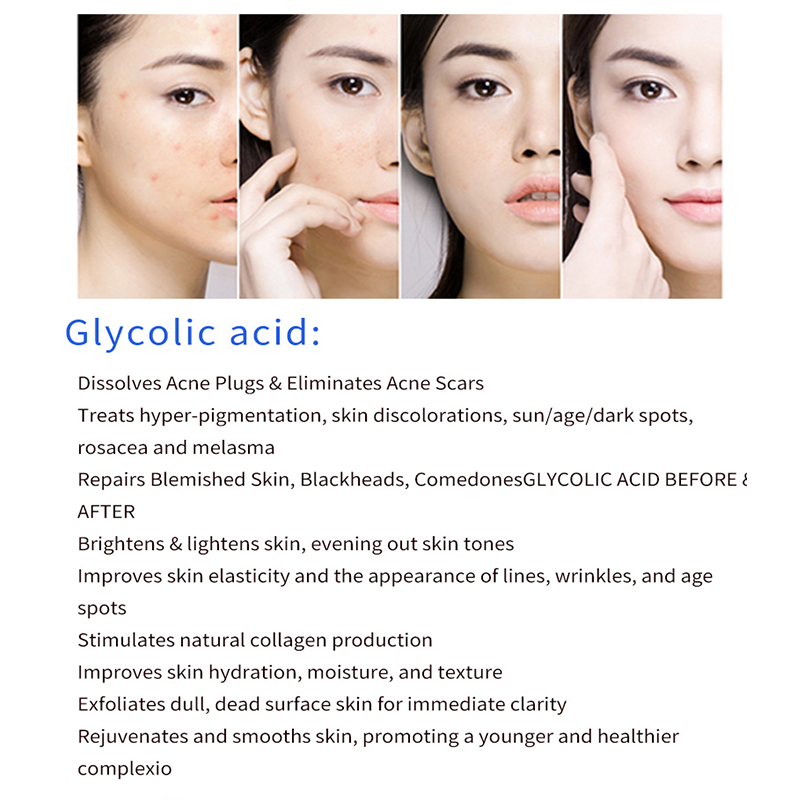 glycolic acid 40% glicolico aha skin glicolic acid peeling remove acne pockmark peeling treatment Back blain blain whelk face