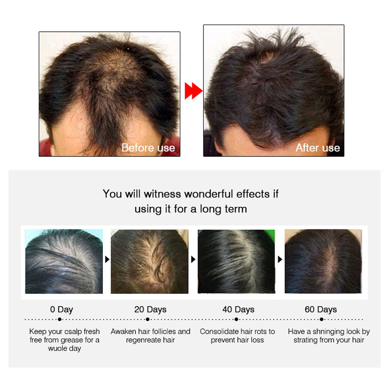ARTISCARE Hair Growth Essential Oil Hair Care Treatment For Men And Women Hair Loss Essence Liquid Repair Hair Root 20ml 5PCS