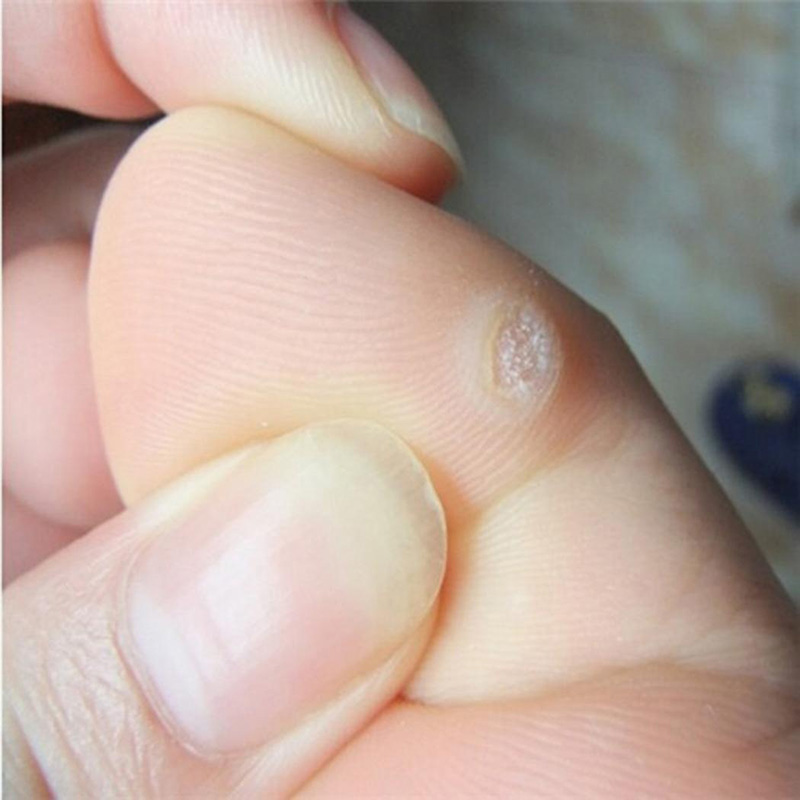 36pcs Foot Corn Killer Calluses Plantar Warts Thorn Pain Relief Plaster Foot Care Tool Medical Sticker Toe Protector