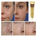 LANBENA Acne Scar Removal Cream Skin Repair Face Cream Acne Spots Treatment Stretch Marks Remove Postpartum Body Skin Cream