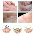 10g Stretch Mark Remover Skin Care Scar Cream From Scar Bio Treatment Cream Oil Body Skin Repair Marks Maternity Care Stret Q6V6