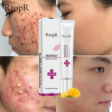 Acne Treatment Face Cream Blackhead Repair Gel Oil Control Shrink Pores Scar Whitening Moisturizer Skin Care Korean Cosmetics