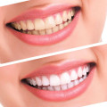 Teeth Whitening 44% Peroxide Dental Bleaching System Oral Gel Kit Tooth Whitener Gel White Teeth Gel 10pcs/6pcs/5pcs/3pcs