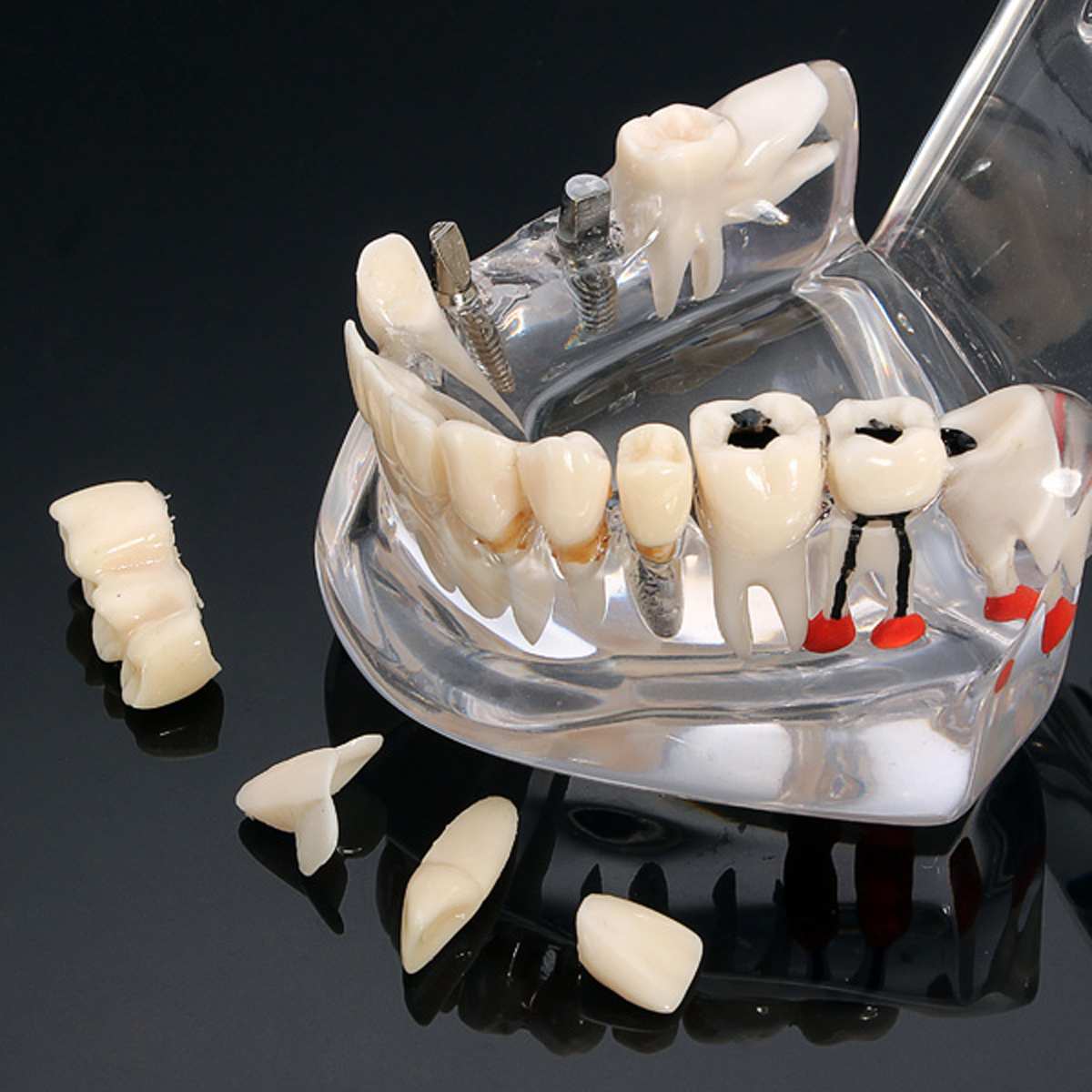 Dental Study Teaching White Teeth Model Caries Tooth Care Oral Education Dentist Equipment Oral Care Tool Disease Teaching Study
