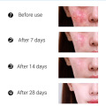 Effective Acne Removal Cream Acne Treatment Fade Acne Spots Oil Control Shrink Pores Whitening Moisturizing Acne Cream Skin Care