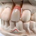 Zircona Crown With Gingival Porcelain