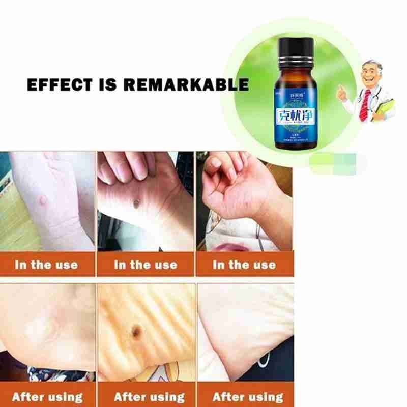 10ml Anti-condyloma Essential Oil Skin Repair Liquid Effective Kill Remover Foot Corn Skin Tag Mole Genital Wart Remover