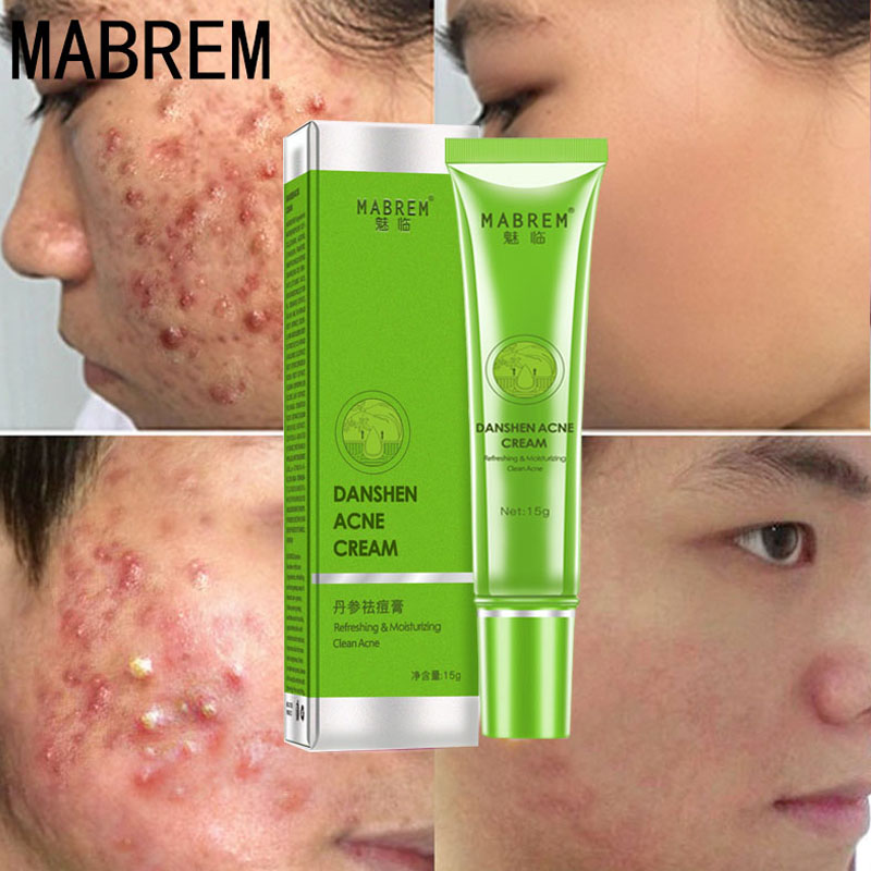 Effective Acne Removal Cream Acne Treatment Fade Acne Spots Oil Control Shrink Pores Whitening Moisturizing Acne Cream Skin Care