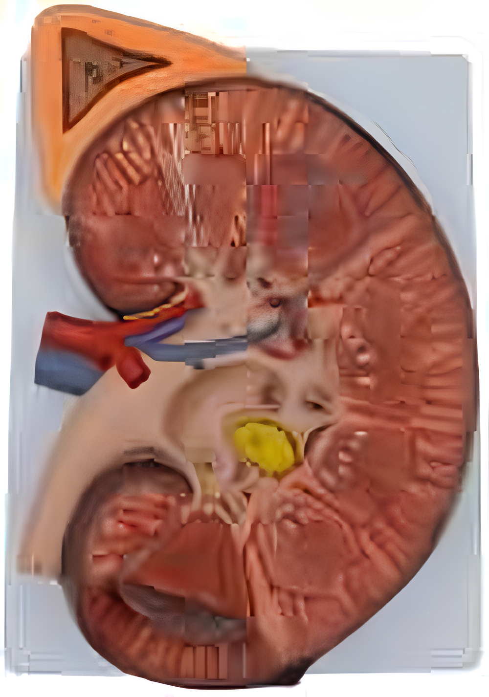 Enlarged Kidney Anatomy Model