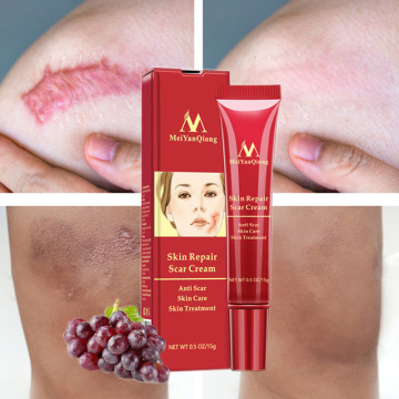 Acne Scar Removal Face Cream Acne Spots Acne Pigmentation Corrector Whitening Cream Anti Scar Stretch Marks Repair Skin Care