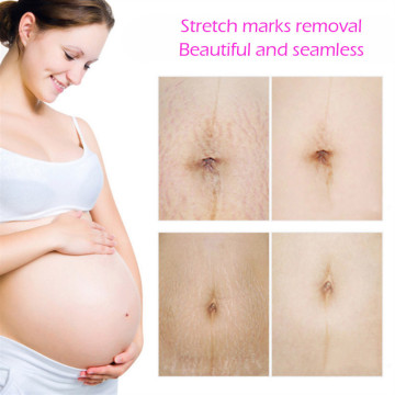 Effectively Repair Stretch Marks Removal Remover Plant Natural Heal Pregnancy Breast Hip Legs Stretch Mark Cream