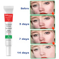 Acne Treatment Face Cream Scar Blackhead Remover Repair Gel Oil Control Shrink Pores Whitening Skin Care Korean Cosmetics