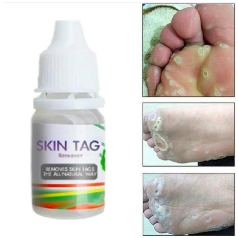 Skin Tag Remover Corn Eye Treatment Solution Corns Exfoliator Callus Removal Liquid Foot Skin Care Product