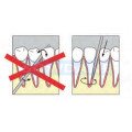 6Pcs Dental Elevator Bean Elevator Oral Tooth Loosening Root Extraction Kit Dental Implant Minimally Invasive without box