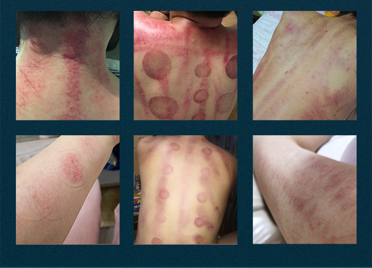 fat cavitation