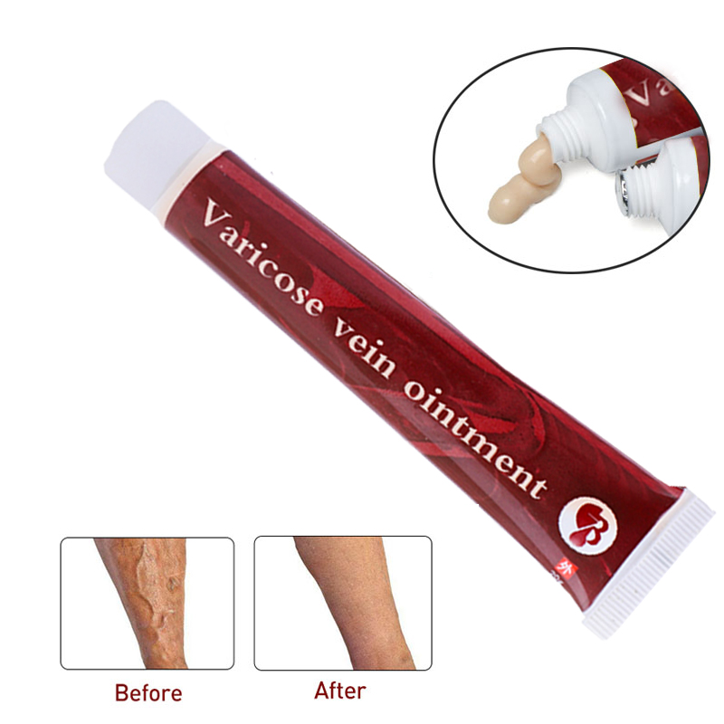 Chinese Natural Herbal Medicine For Treating Varicose Vascular Inflammation Massage Cream Cure Varicose Vein Ointment