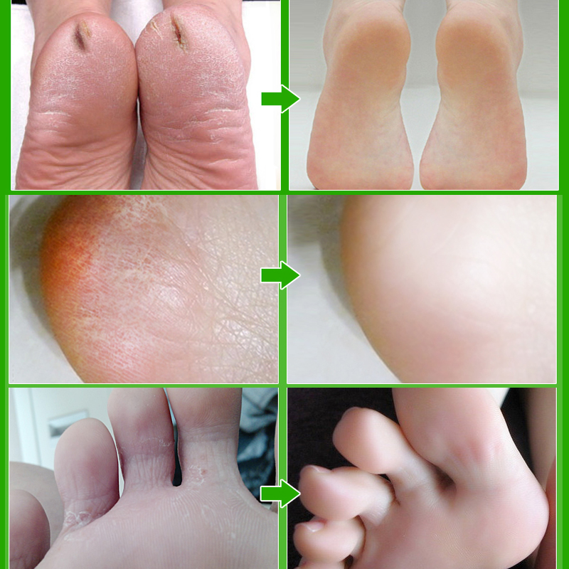 Horse Oil Anti Fungal Foot Cream Relieve Beriberi Anti Dry Crack Repair Moisturizing Feet Treatment Fungal Infection Skin Care
