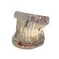 2021 New Dental Disease Implant Teeth Model with Restoration Bridge Tooth Dentist for medical Science Disease Teaching Study