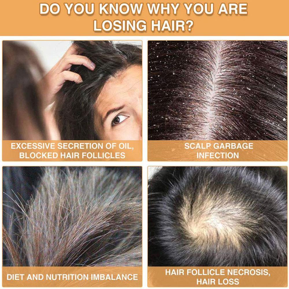 1pc 7X Rapid Growth Hair Treatment Anti Hair Loss Fast Ginger Oil 30ml Growth Hair Serum Essential Y4O5