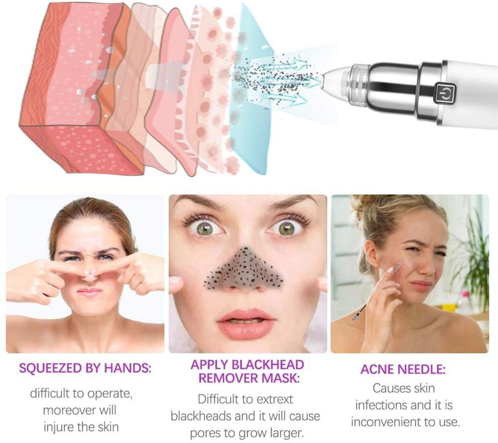 Mini Microdermabrasion Blackhead Remover Vacuum Suction Face Pimple Acne Comedone Extractor Facial Pores Cleaner for Home Use