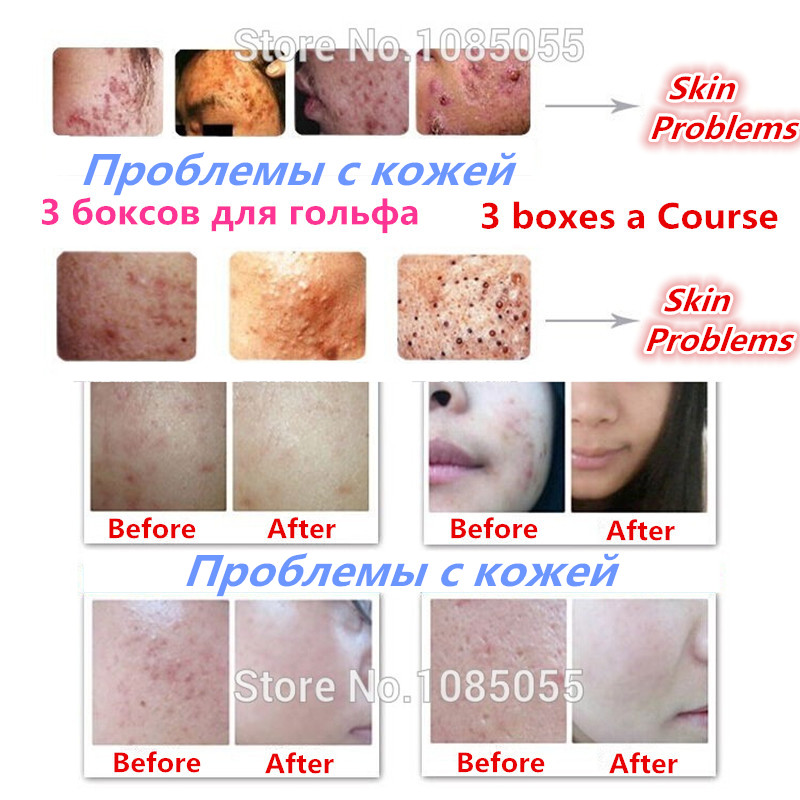 Face Acne Cleaning Cream Skin Care Remove Repair Comedone Pimple Acne Quickly Face Acne Cream Remover Anti Acne Treatment
