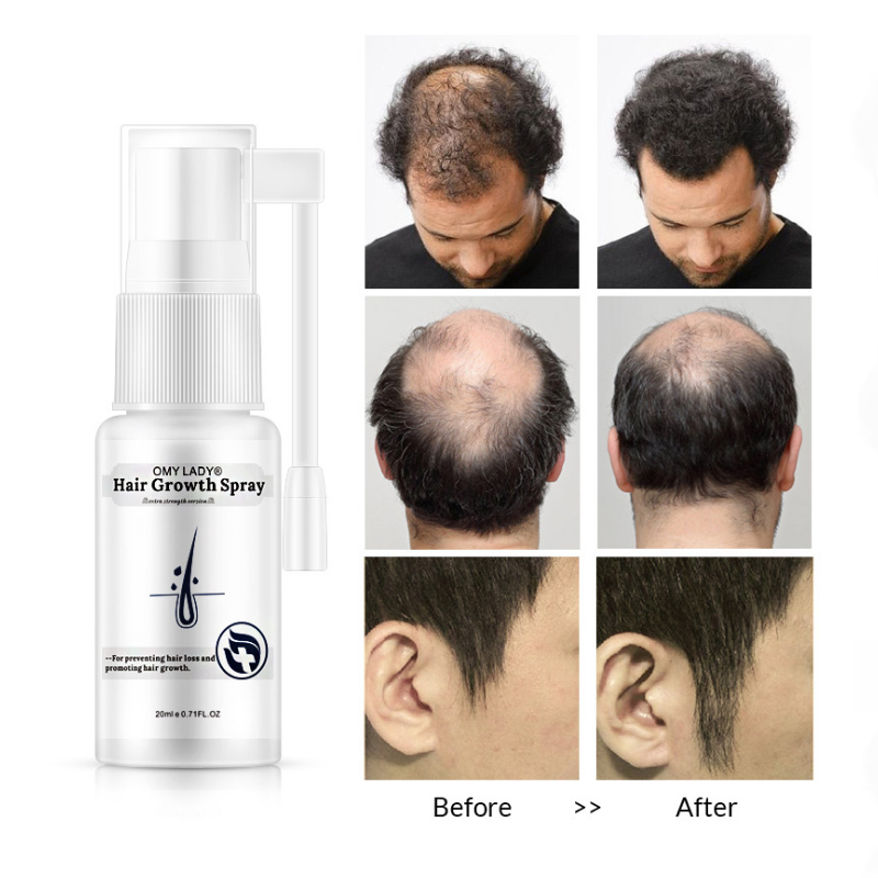 OMY LADY Anti Hair Loss Hair Growth Spray Essential Oil Liquid For Men Women Dry Hair Regeneration Repair,Hair Loss Products