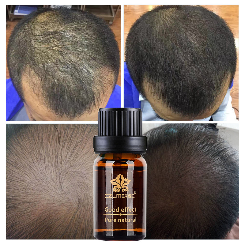 CZLMI 10ML Hair Growth Essence Hair Repair Treatment Liquid Regrowth Essential Oil Serum Preventing Hair Loss Fast Restoration