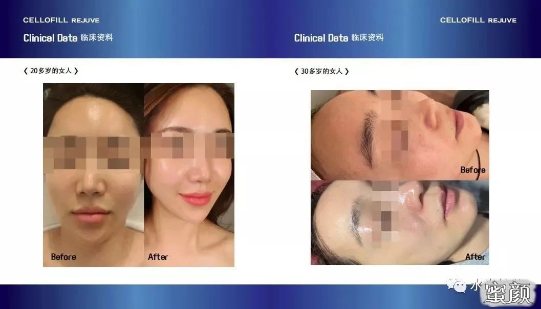 2022-New-Top-Selling-Korea-Origin-Chanel-Cellofill-Rejuve-for-Skin-Face-Reguventing-Anti-Aging-3ml-6vials-Skin-Booster-Dermal-Filler-Injection.webp (2)