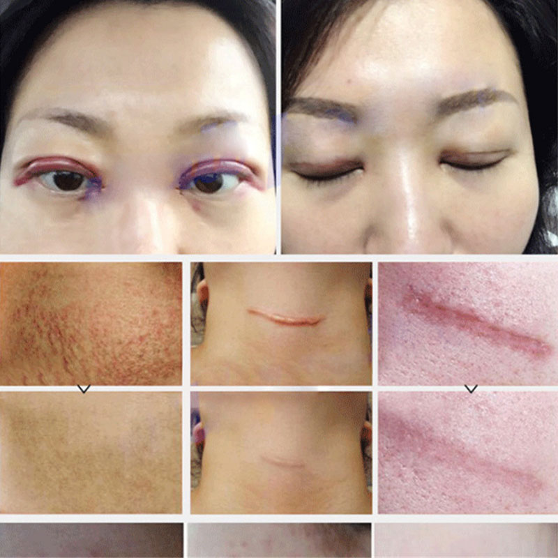 Acne Scar Removal Face Cream Acne Spots Acne Pigmentation Corrector Whitening Cream Anti Scar Stretch Marks Repair Skin Care