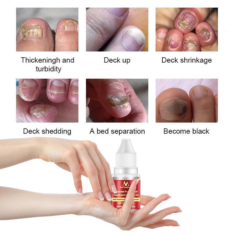 New Chinese Cream Nails Finger Toe Protector Fungus Treatment Herb Health Tools Onychomycosis Paronychia Infection Skin Care