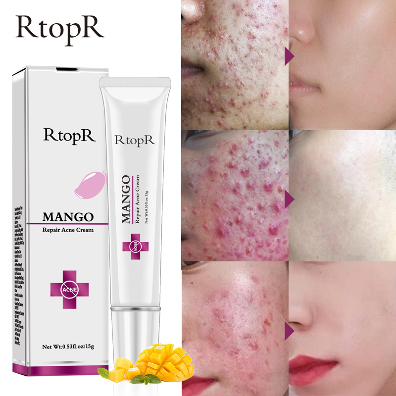 Mango Repair Acne Cream Anti Spots Acne Treatment Scar Blackhead Cream Shrink Pores Whitening Moisturizing Face Skin Care