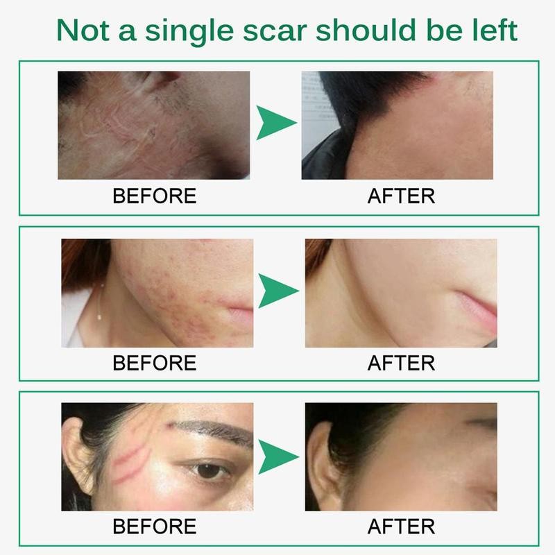 50g Acne Mark Removal Cream Scars Acne Cream Stretch Marks Relief Burns Repair Anti-aging Anti-winkles Scar Removal Cream