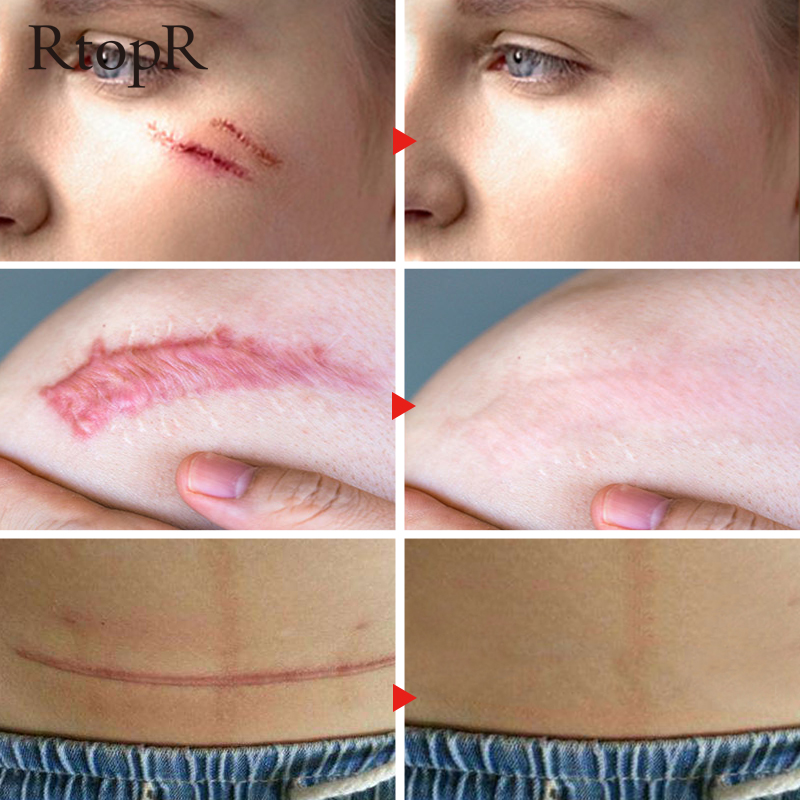 Acne Scar Stretch Marks Remover Cream Skin Repair Face Cream Acne Spots Acne Treatment Blackhead Whitening Cream Skin Care 3pcs