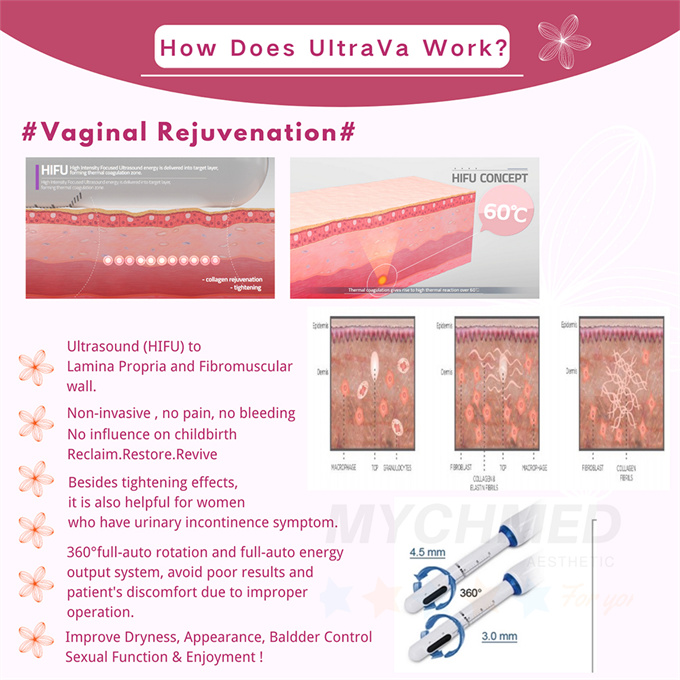 Hifu Vaginal Machine4