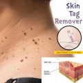 Skin Tag Remover Corn Eye Treatment Solution Corns Exfoliator Callus Removal Liquid Foot Skin Care Product