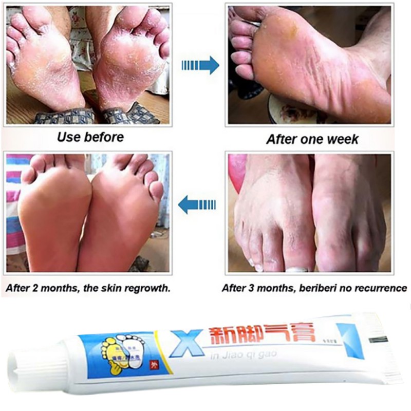 Foot Odor Treatment Foot Care Cream Smelly Itching Ointment Chinese Medicine Feet Care Cream Wholesale