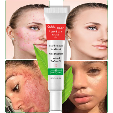 Acne Treatment Face Cream Scar Blackhead Remover Repair Gel Oil Control Shrink Pores Whitening Skin Care Korean Cosmetics