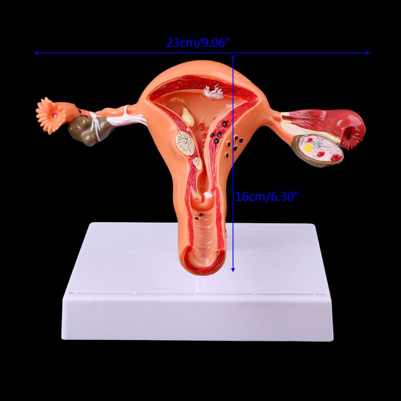 Medical props model Free postage Pathological Uterus Ovary Anatomical Model Anatomy Cross Section Study Tool