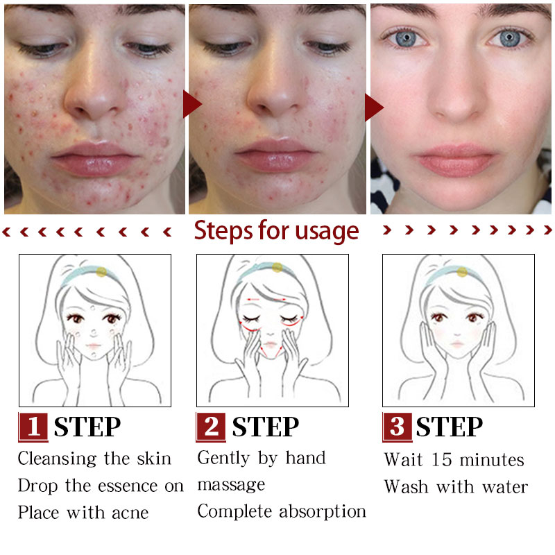 Acne Treatment Face Serum Centella Asiatica Oil Control Shrink Pores Scar Essence Whitening Moisturizer Skin Care MeiYanQiong
