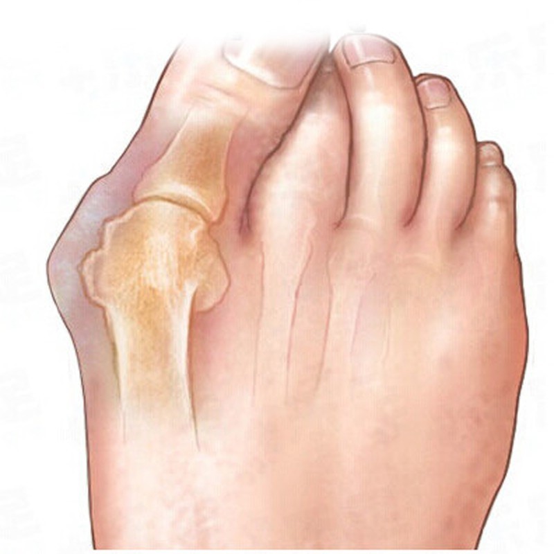 pedicur Silicone Gel Foot Toe Separator & Thumb Hallux Valgus Protector&Bunion Adjuster Bicyclic Thumb Orthopedic Braces Correct
