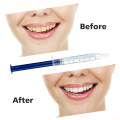 Teeth Whitening Kit 44% Peroxide Dental Bleaching Treatment System Stain Remover Oral Gel Set Tooth Whitener Dental Tooth Care