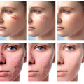 Cayman Serum Women Skin Scar Acne Estrias Mark Removal Gel Face Body Acne Postpartum Repair Crema Hidratante Facial Pimple Patch